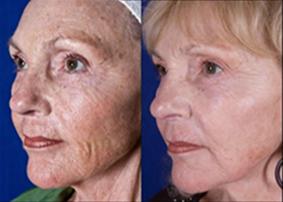 Skin-Changes-Induced-by-Aging
